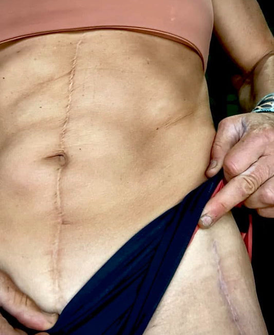 From Surgery to Comeback - Total Hip Replacement